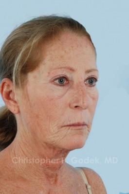 Laser Resurfacing Before & After Image