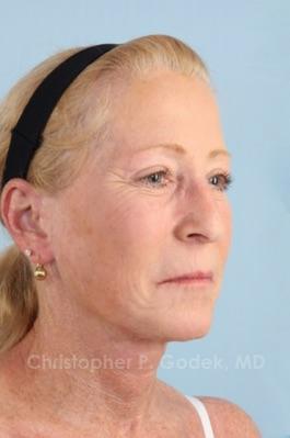 Laser Resurfacing Before & After Image