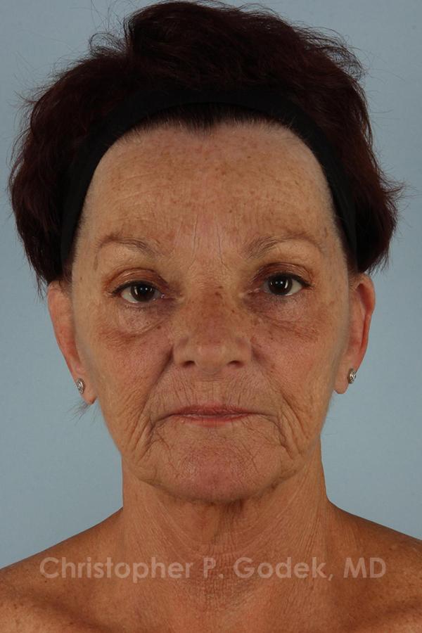 Laser Resurfacing Before & After Image