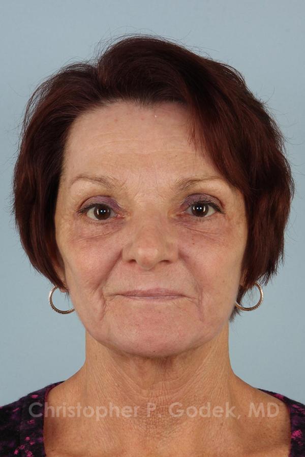 Laser Resurfacing Before & After Image
