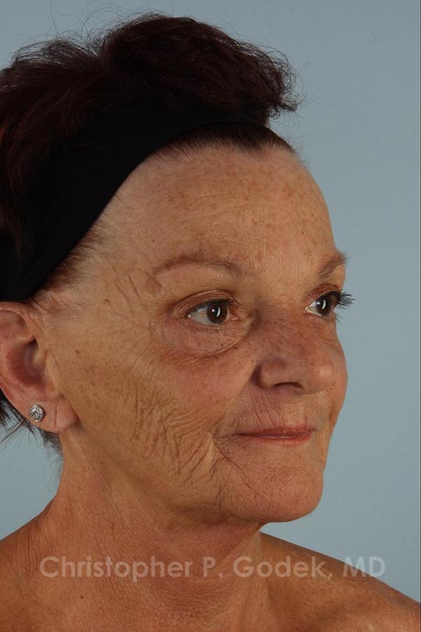 Laser Resurfacing Before & After Image