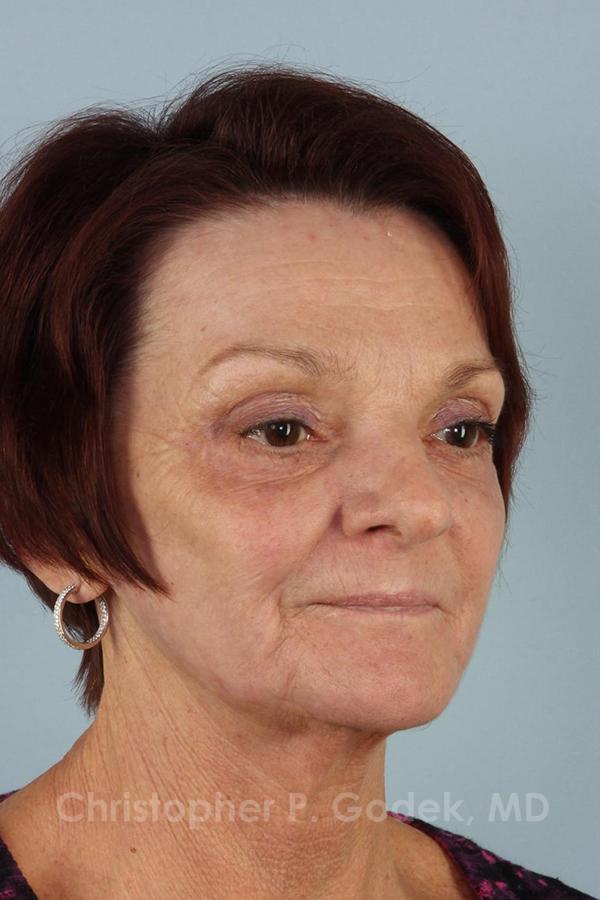 Laser Resurfacing Before & After Image