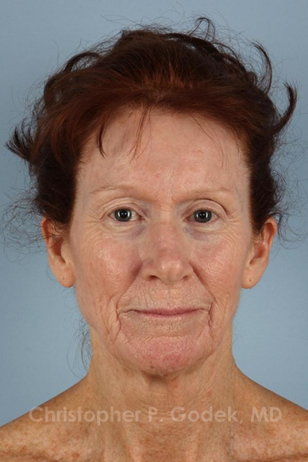 Laser Resurfacing Before & After Image