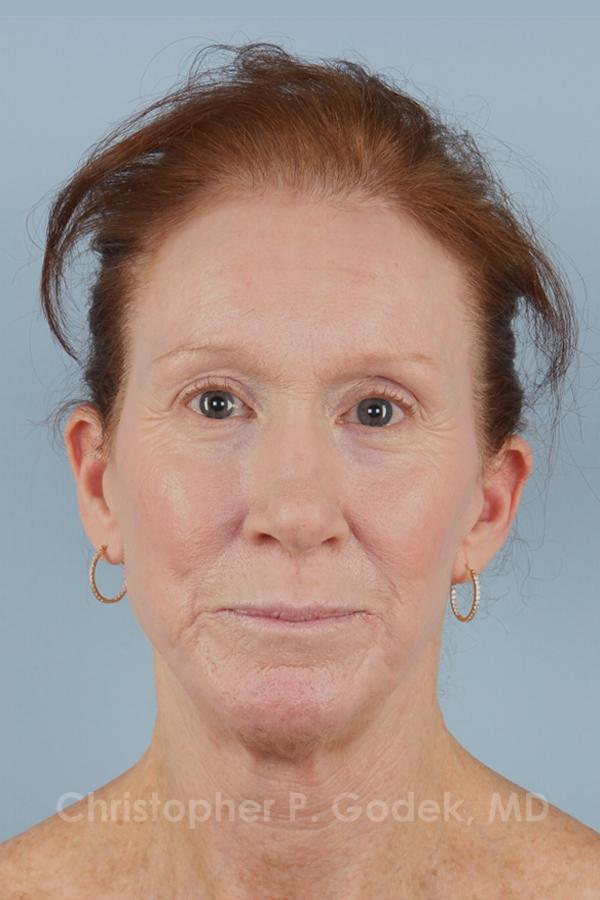 Laser Resurfacing Before & After Image