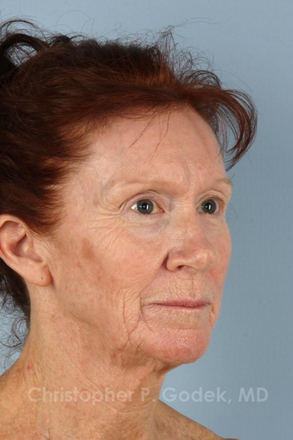 Laser Resurfacing Before & After Image