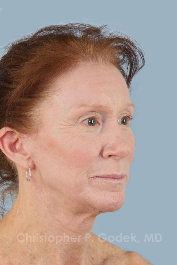 Laser Resurfacing Before & After Image