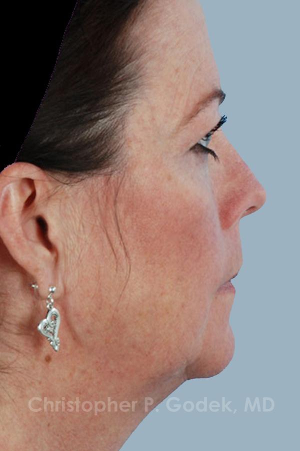 Neck Contouring Before & After Image