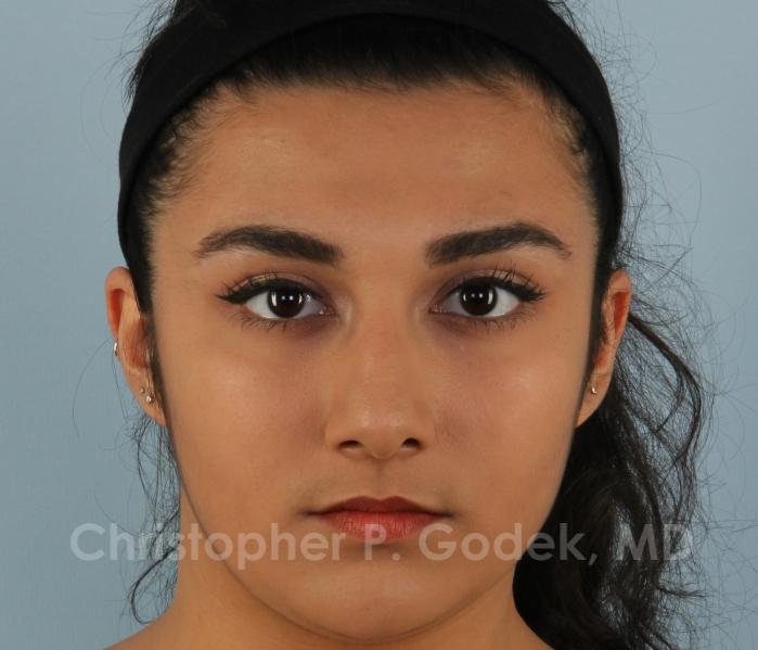 Rhinoplasty  Before & After Image