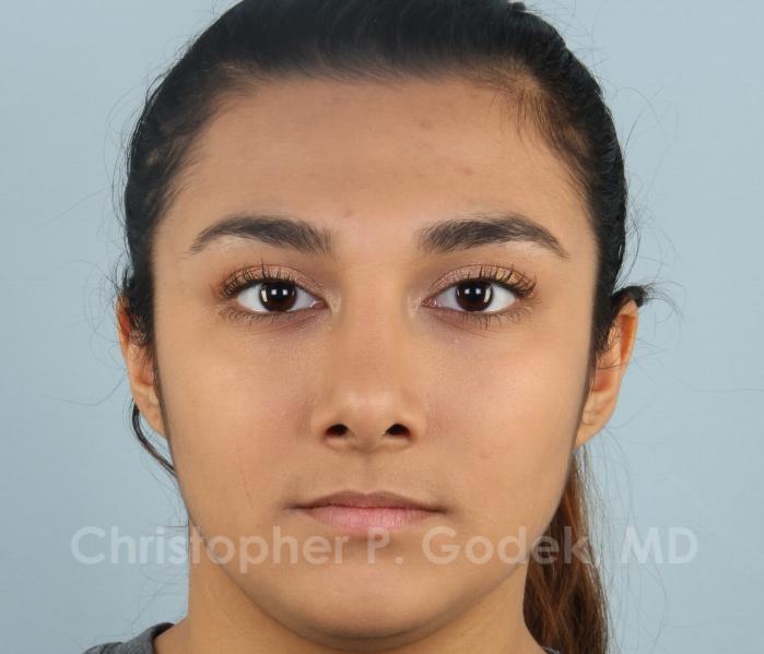 Rhinoplasty  Before & After Image