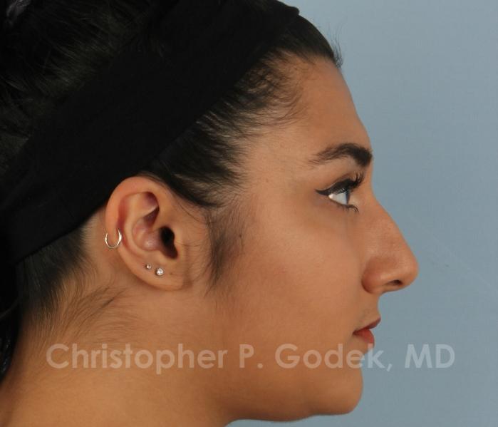 Rhinoplasty  Before & After Image