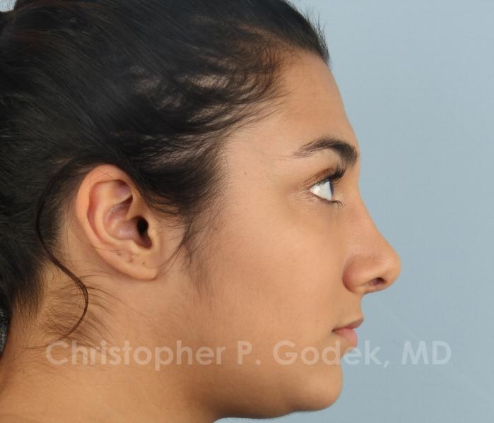 Rhinoplasty  Before & After Image