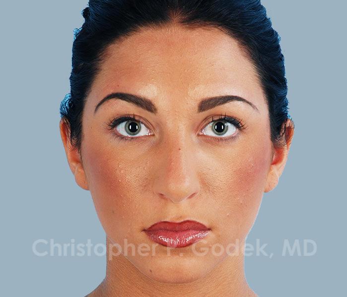 Rhinoplasty  Before & After Image