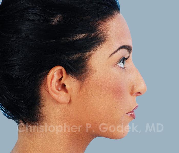 Rhinoplasty  Before & After Image