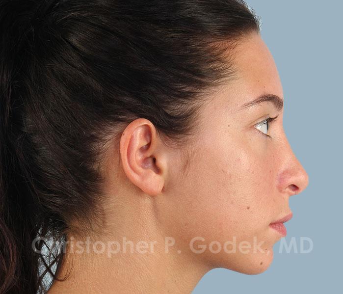 Rhinoplasty  Before & After Image