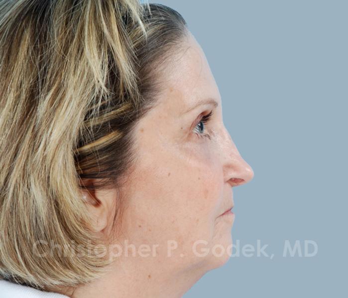 Rhinoplasty  Before & After Image