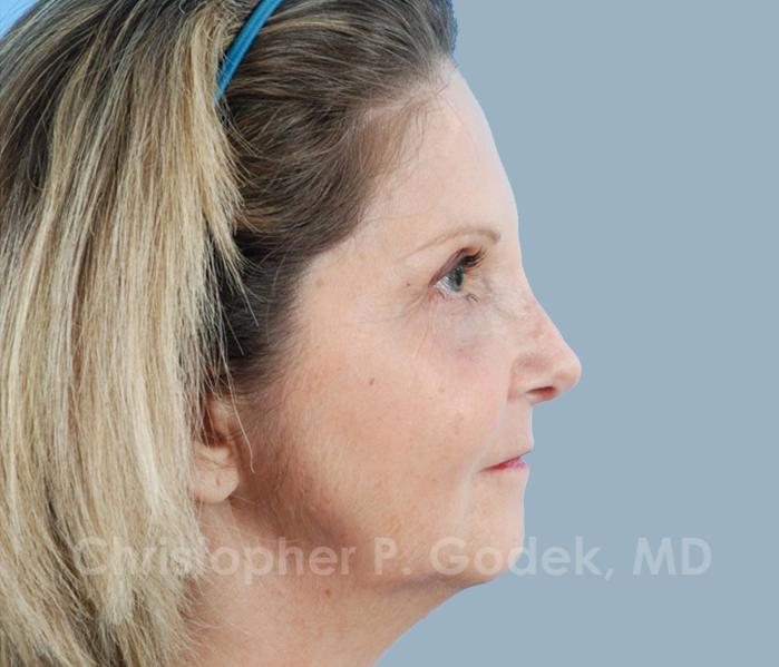 Rhinoplasty  Before & After Image