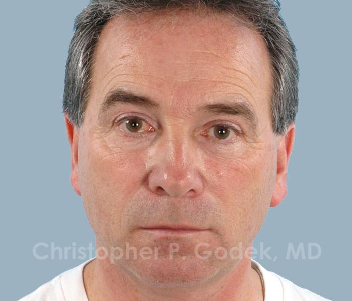 Rhinoplasty  Before & After Image