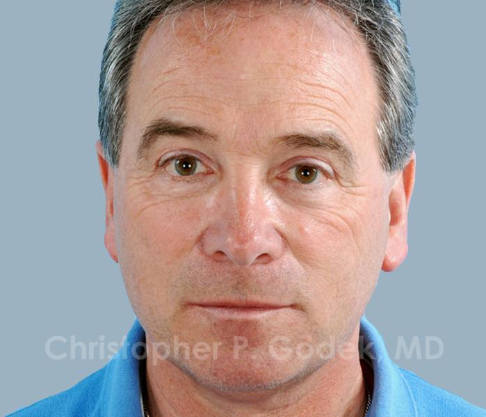 Rhinoplasty  Before & After Image