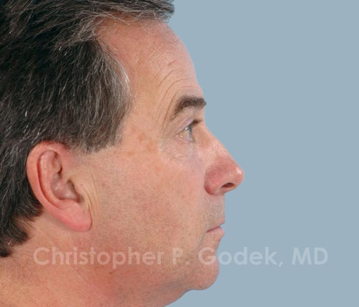 Rhinoplasty  Before & After Image