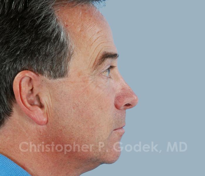 Rhinoplasty  Before & After Image