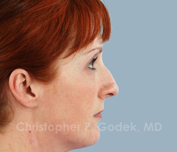 Rhinoplasty  Before & After Image