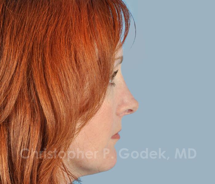 Rhinoplasty  Before & After Image