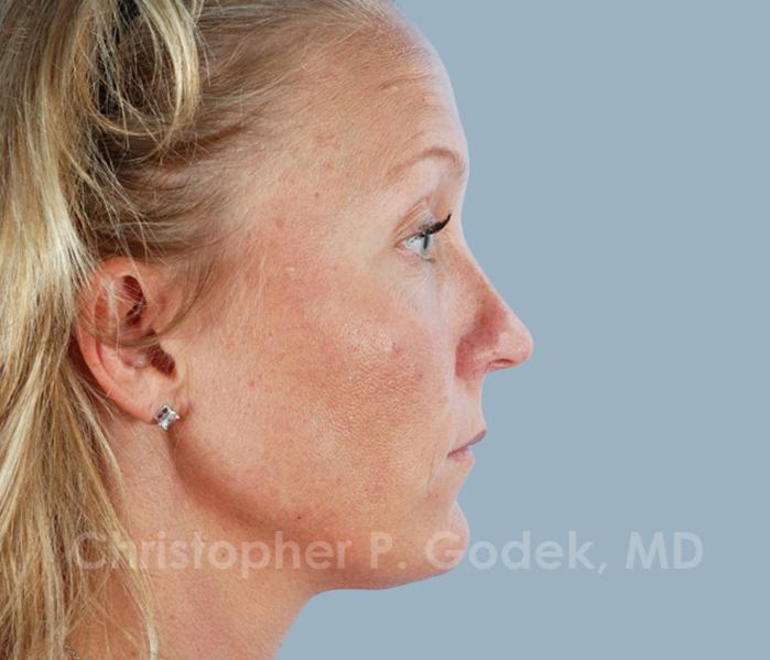 Rhinoplasty  Before & After Image