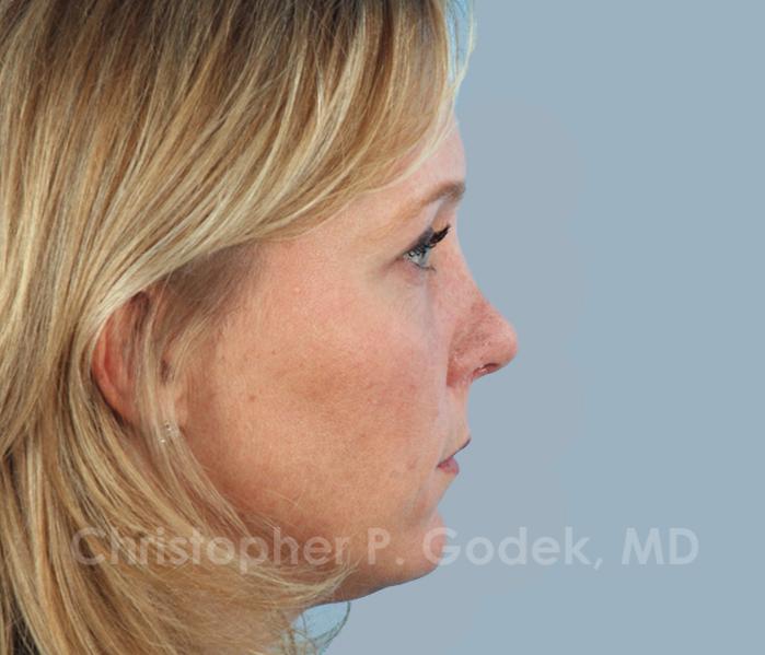 Rhinoplasty  Before & After Image