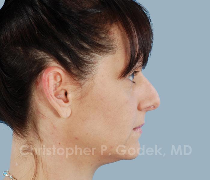 Rhinoplasty  Before & After Image