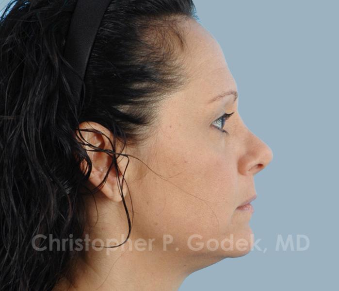 Rhinoplasty  Before & After Image