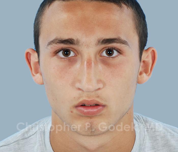 Rhinoplasty  Before & After Image