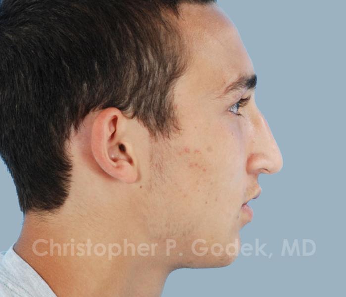 Rhinoplasty  Before & After Image