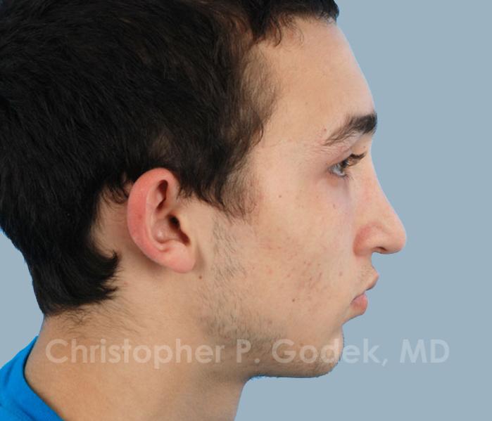 Rhinoplasty  Before & After Image