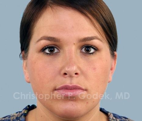 Rhinoplasty  Before & After Image