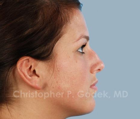 Rhinoplasty  Before & After Image