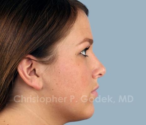 Rhinoplasty  Before & After Image