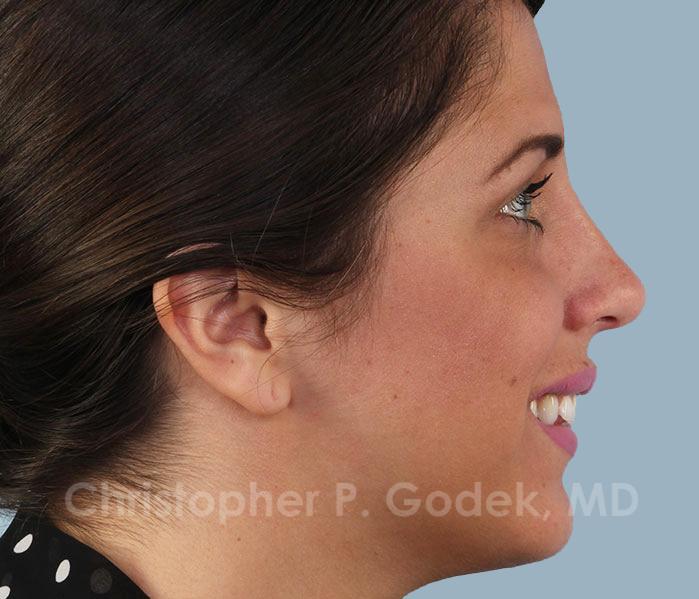 Rhinoplasty  Before & After Image