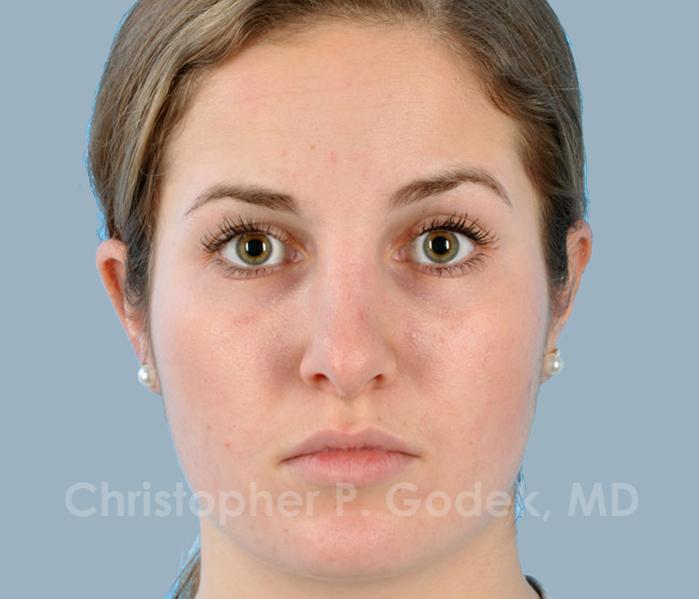 Rhinoplasty  Before & After Image