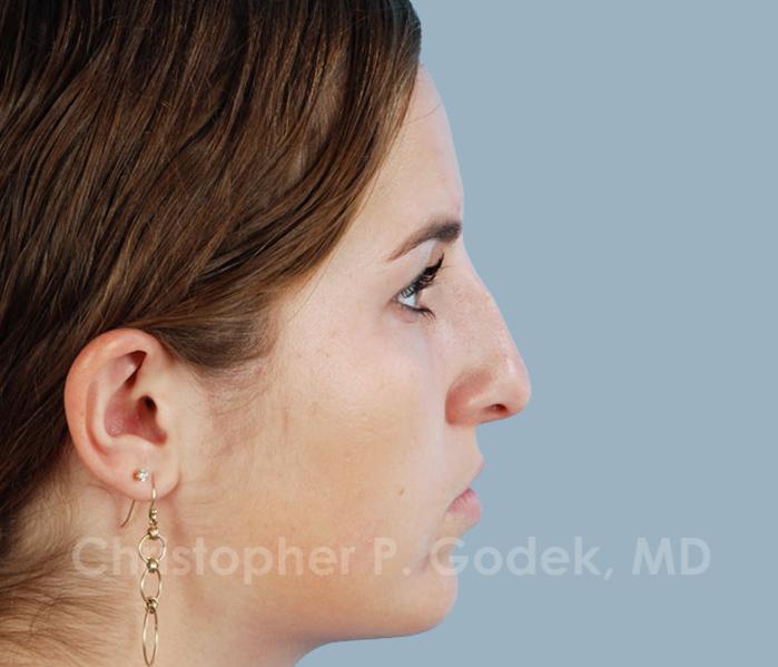 Rhinoplasty  Before & After Image