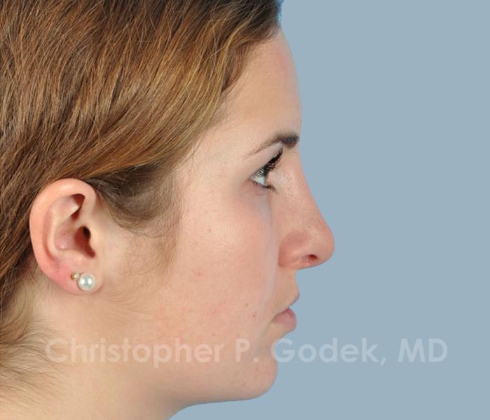 Rhinoplasty  Before & After Image