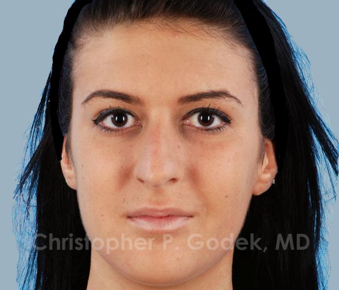 Rhinoplasty  Before & After Image