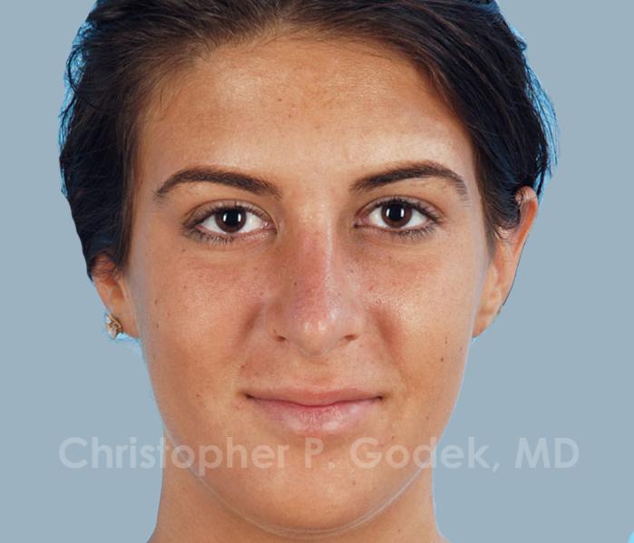 Rhinoplasty  Before & After Image