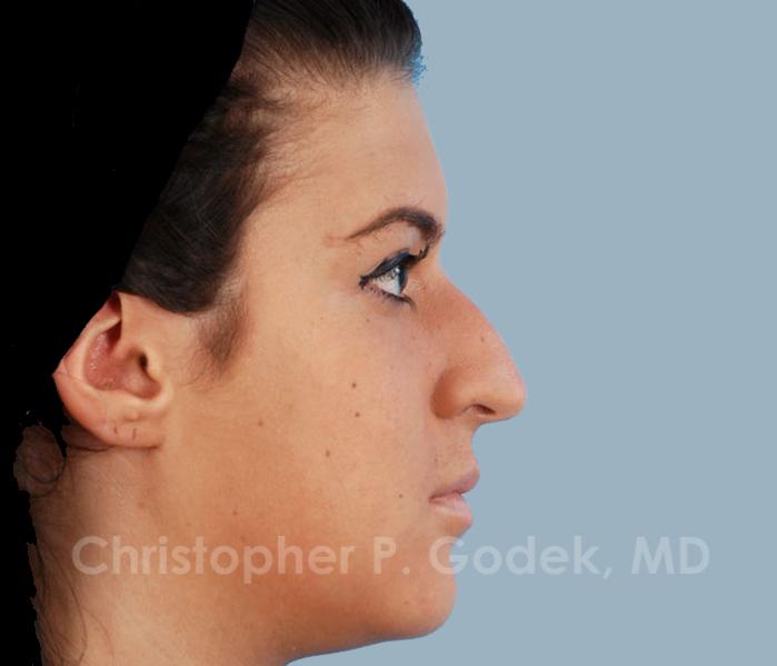 Rhinoplasty  Before & After Image