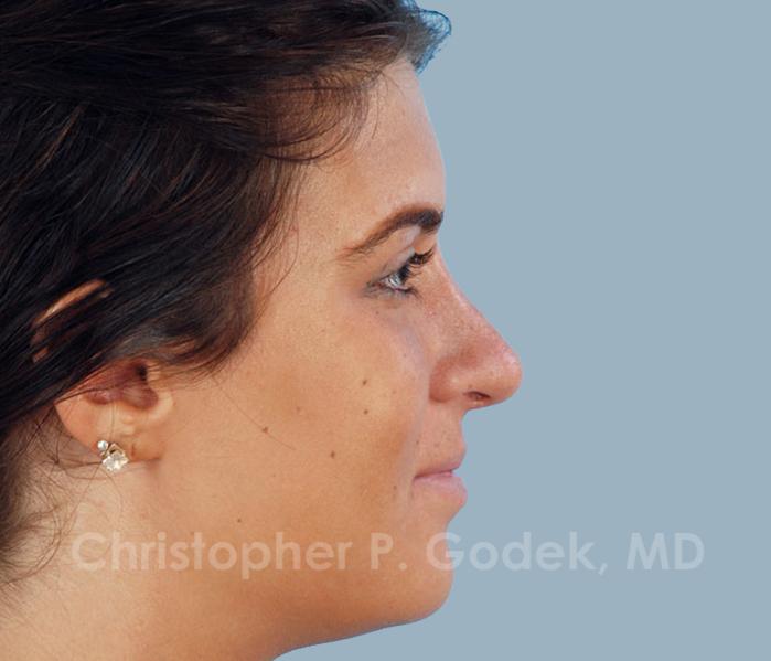 Rhinoplasty  Before & After Image