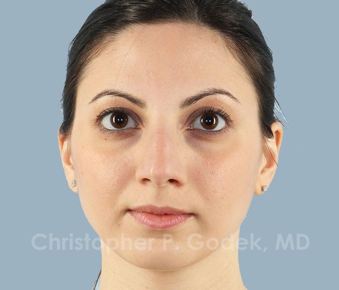 Rhinoplasty  Before & After Image