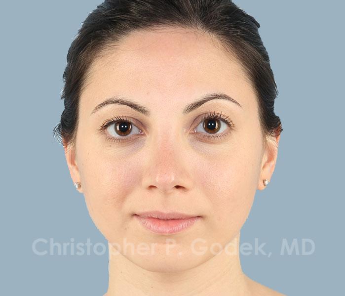 Rhinoplasty  Before & After Image