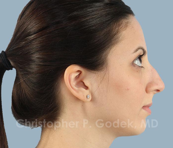 Rhinoplasty  Before & After Image