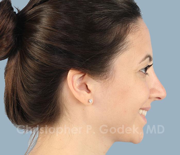 Rhinoplasty  Before & After Image