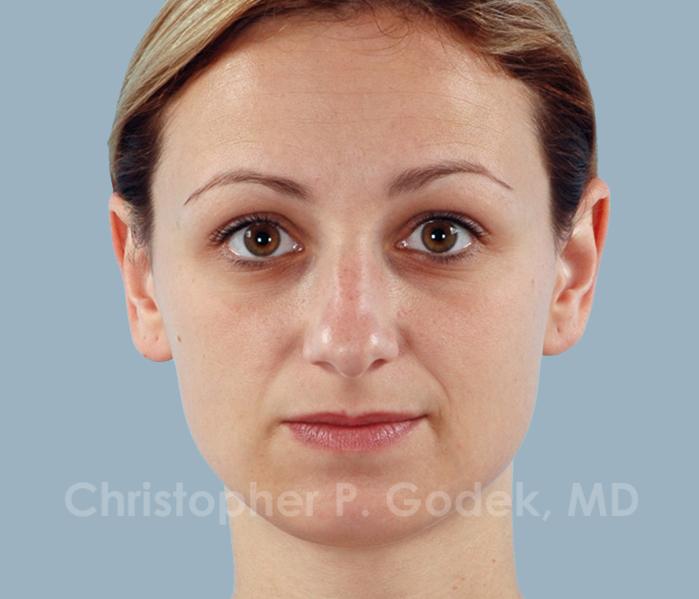 Rhinoplasty  Before & After Image