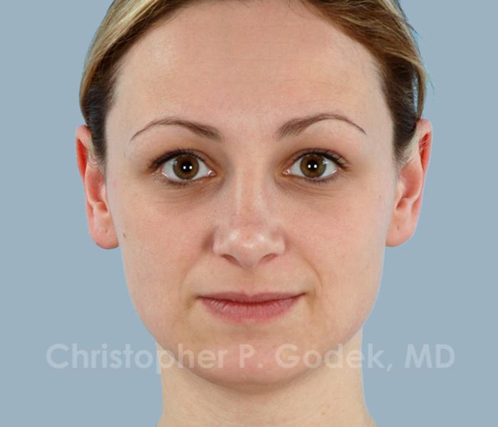 Rhinoplasty  Before & After Image